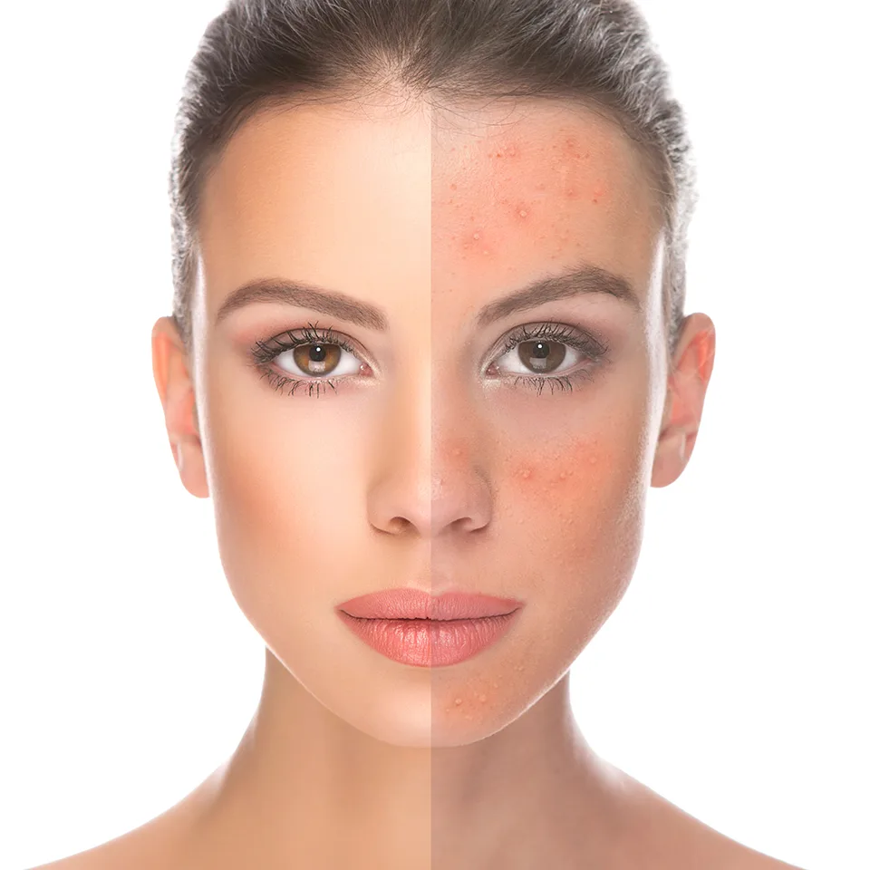 DERMIS-ACNE