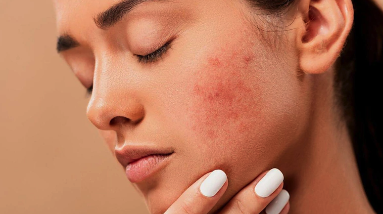 Treating acne and acne scars with laser