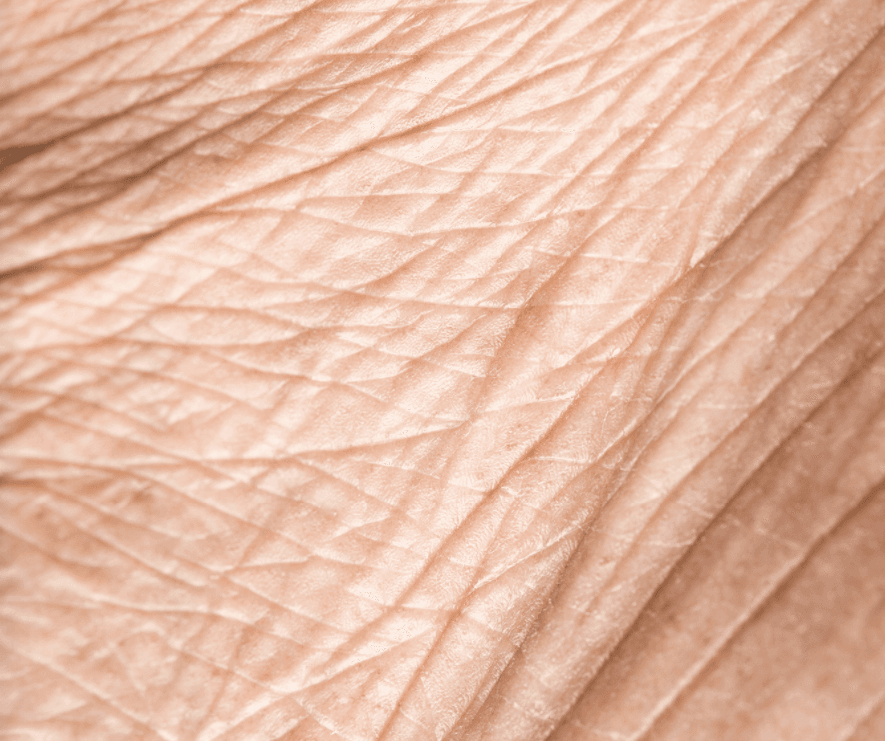 Types of wrinkles and treatments - Dermis Advanced Skin Care